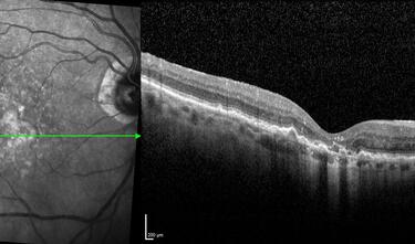 Clase 18 - Signos estructurales diferenciales entre neurodegeneración y exudación en DMAE