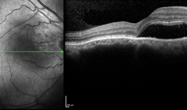 Clase 19 - Actualización de enfermedades paquicoroideas