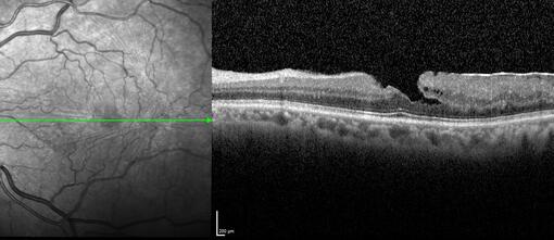 Clase 20 - Signos clave en patología traccional vítrorretiniana