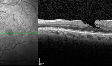 Clase 20 - Signos clave en patología traccional vítrorretiniana