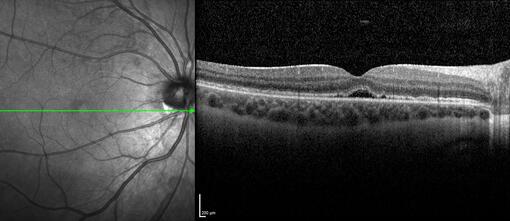 Clase 21 - Desprendimiento de vítreo y desprendimiento de retina