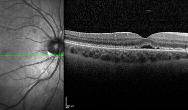 Clase 21 - Desprendimiento de vítreo y desprendimiento de retina