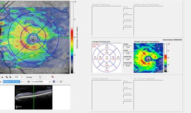 Clase 4 - Casos clínicos rutinarios con moraleja en glaucoma