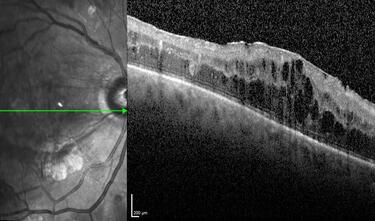 Clase 5 - Signos clave en diabetes ocular
