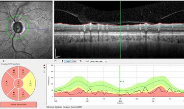 Clase 3 - Más allá de la interopretación de OCT estructural papilar. Correlación histológica