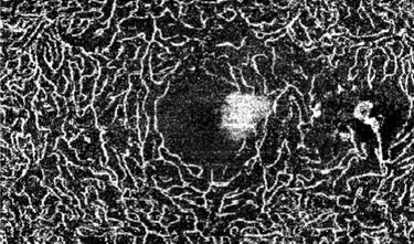 Clase 2 - Más alla de la interpretación de OCT. Angiografía macular.