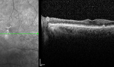 Clase 7 - Isquemia retiniana del plexo superficial y profundo