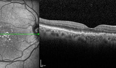 Clase 13 - Clasificación actualizada de la DMAE
