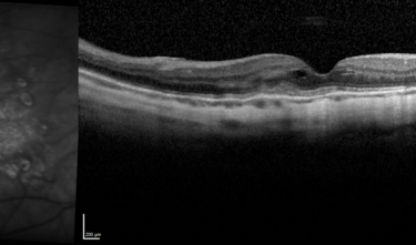 Clase 9 - Particularidades del examen macular en miopía