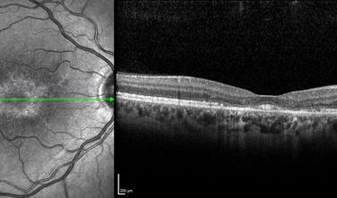 Clase 10 - Signos peculiares en oftalmología pediátrica general