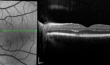 Clase 11 - Signos clave en uveítis posteriores