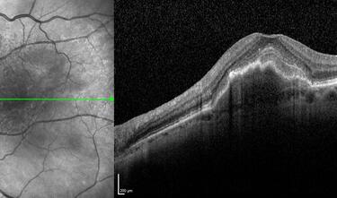  Clase 17 - Actualización en el fenotipado neovascular en DMAE 