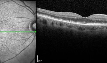 Clase 14 - Tipos de drusas y sus implicaciones particulares