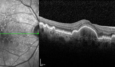 Clase 15 - Depósitos y signos específicos en DMAE no neovascular
