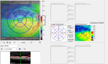 Clase 6 - Signos clave en patología venosa oclusiva