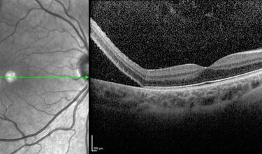 Clase 22 - Actualización en OCT intraoperatoria